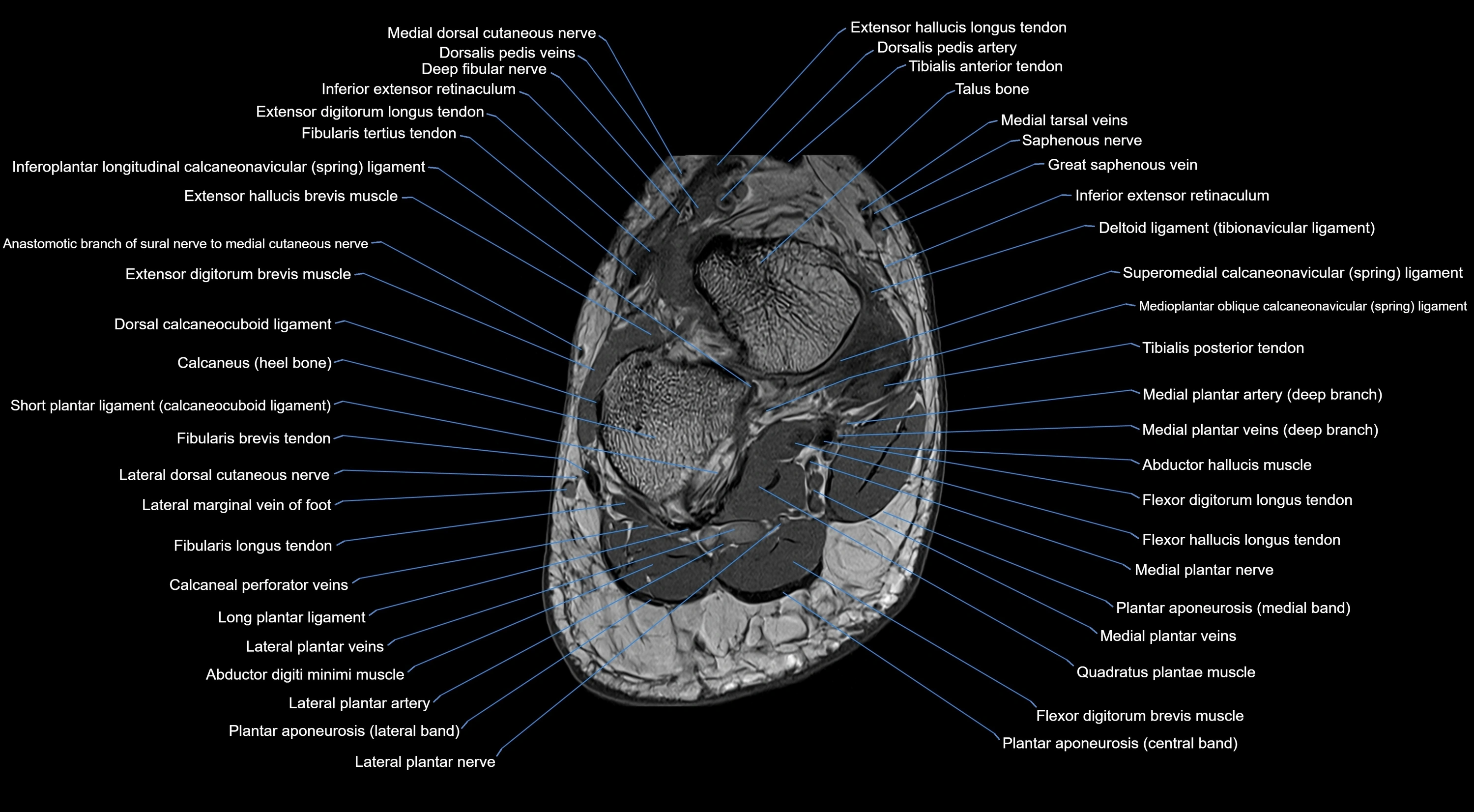 MRI mid foot coronal ligaments cross sectional anatomy 3T  radiology  image-img-00001-00038.webp